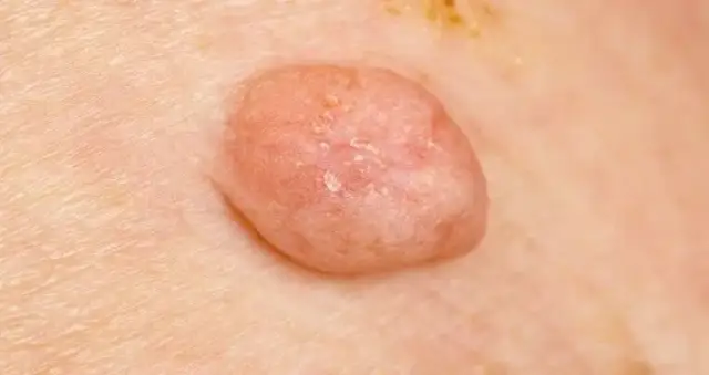 Kłykciny kończyste: do dermatologa, urologa czy ginekologa?