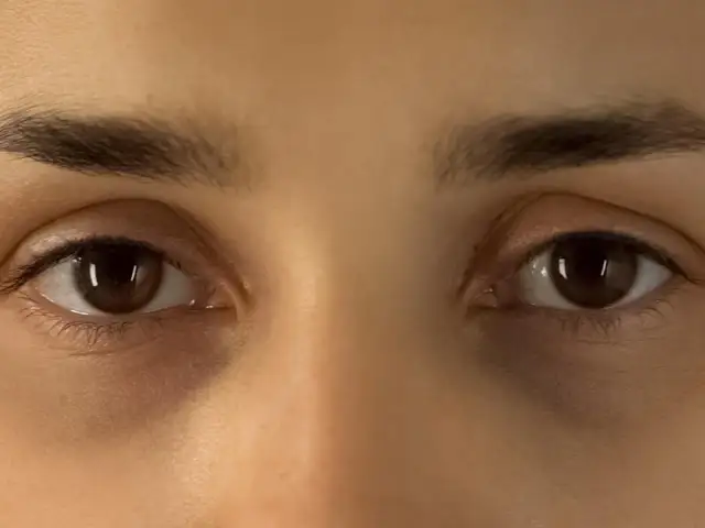 Nahaufnahme von Augen mit dunklen Ringen unter den Augen.