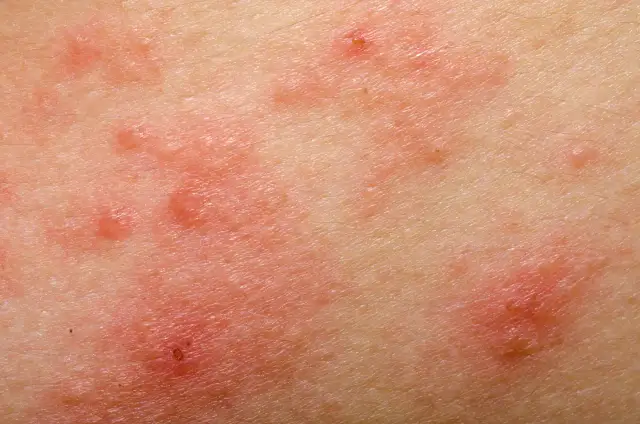 Czy pelargonie uczulają? Objawy alergii i bezpieczne odmiany