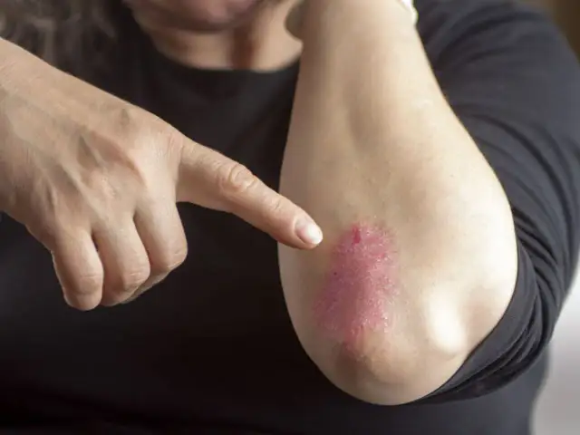 Dłoń wskazuje na łokieć z czerwonymi, suchymi plamami na skórze, które mogą być objawem problemów dermatologicznych.