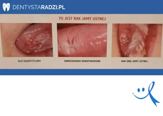 Rak jamy ustnej: wczesne objawy, które musisz znać (do 70 znaków)