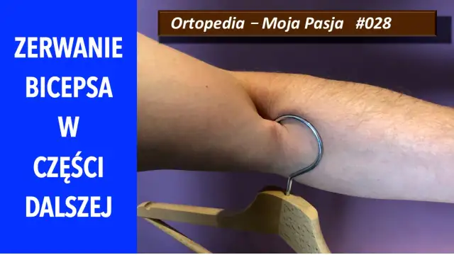 ZOBACZ objawy zerwania bicepsa w części dalszej. Na zdjęciu widać zgięte ramię z wieszakiem zaczepionym o skórę.