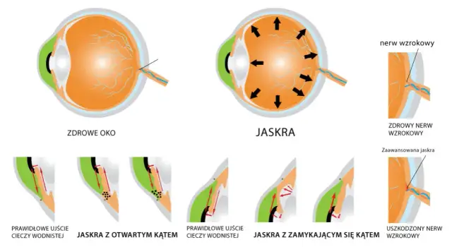 Od czego jest jaskra? Poznaj przyczyny i ryzyko tej choroby oczu