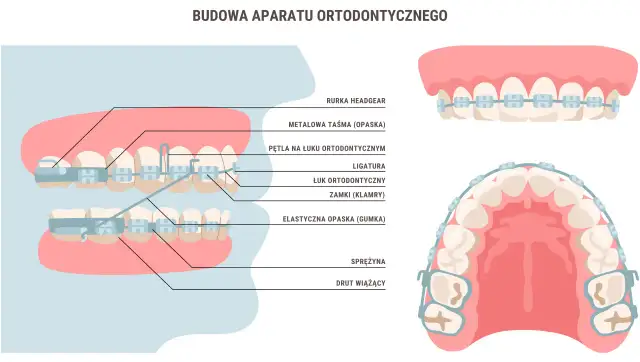 Aparat ortodontyczny: Kiedy zacząć i jakie warunki musisz spełnić?