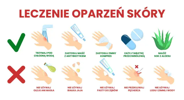 Pierwsza pomoc przy oparzeniach - Jak rozpoznać stopnie i działać?