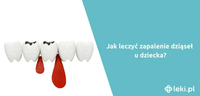 Zapalenie dziąseł u dziecka: Ile trwa? Objawy, leczenie, porady eksperta