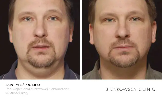 Przed i po zabiegu lipolizy podbródka. Widoczna redukcja tkanki tłuszczowej i poprawa napięcia skóry.
