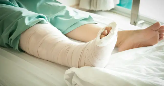 Noga w gipsie leży na szpitalnym łóżku. Palce stopy wystają z opatrunku, czekając na powrót do zdrowia.