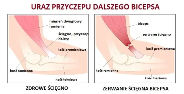Naderwany biceps: 5 kluczowych objawów, które musisz znać