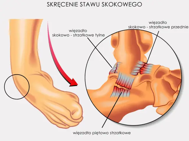 Ilustracja pokazuje skręcenie stawu skokowego, uwypuklając więzadła i mięśnie. Czerwona strzałka wskazuje kierunek urazu.