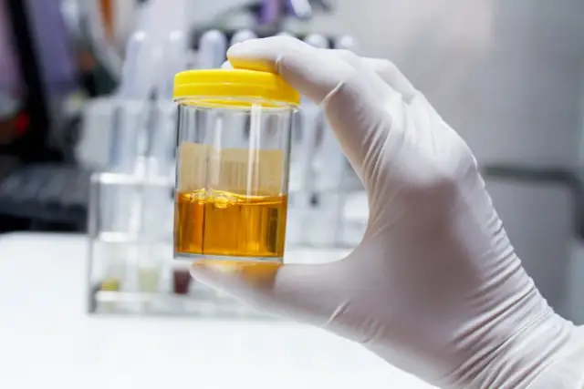 Posiew moczu: precyzyjna diagnoza ZUM. Co wykrywa i jak czytać?