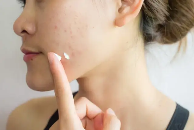 Pasta do zębów na pryszcze? Dermatolodzy: To mit i szkoda dla skóry