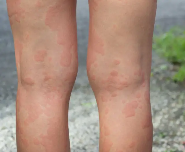 Alergia na słońce objawy: Zobacz, jak rozpoznać niebezpieczne reakcje