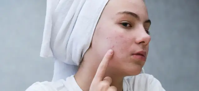 Dziewczyna z ręcznikiem na głowie pokazuje palcem zaczerwienioną skórę z pryszczami, szukając sposobu, jak pozbyć się dużego pryszcza.