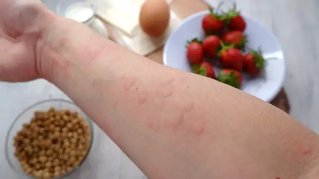 Ręka z wysypką alergiczną, w tle truskawki, jajko i fasola.