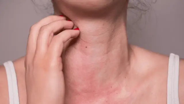 Alergia na słońce: objawy, przyczyny i jak sobie z nią radzić?