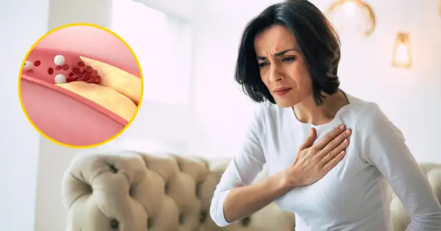 Kobieta trzymająca się za serce obok schematu zatkanego cholesterolem naczynia krwionośnego.