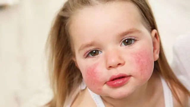 Alergia pokarmowa u dzieci: objawy, diagnoza i co robić?