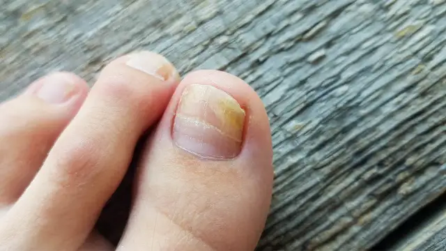 Grzybica paznokci: Kto pomoże? Dermatolog, podolog i skuteczne leczenie