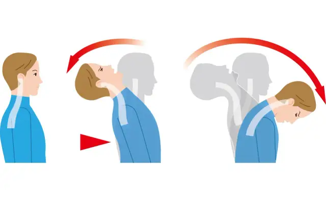 Illustration zeigt die Bewegung des Kopfes bei einem Schleudertrauma.