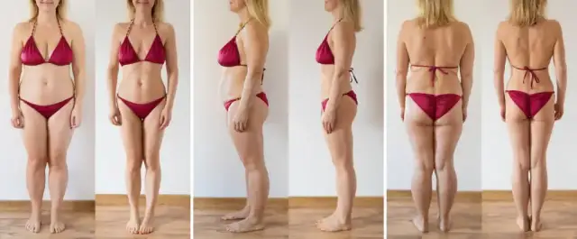 Liposukcja: Czy jest bezpieczna? Ryzyko, metody i rekonwalescencja