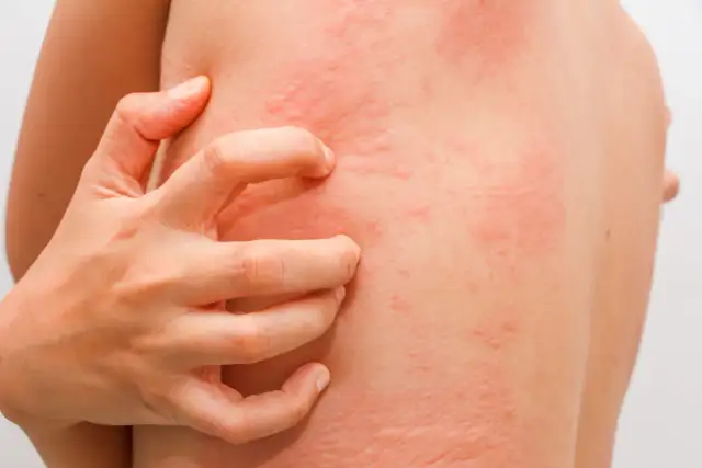 Uczulenie na penicylinę - Zrozum, zdiagnozuj, bezpiecznie zarządzaj