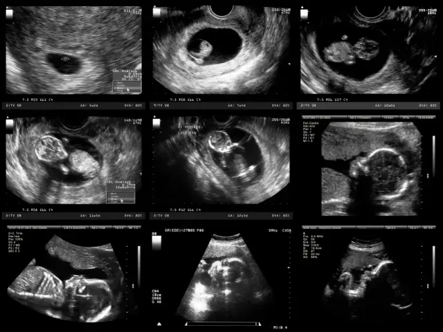 Badania prenatalne 2 trymestr: Twój przewodnik po zdrowiu dziecka