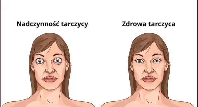 Nadczynność tarczycy objawy psychiczne - jak je rozpoznać i leczyć