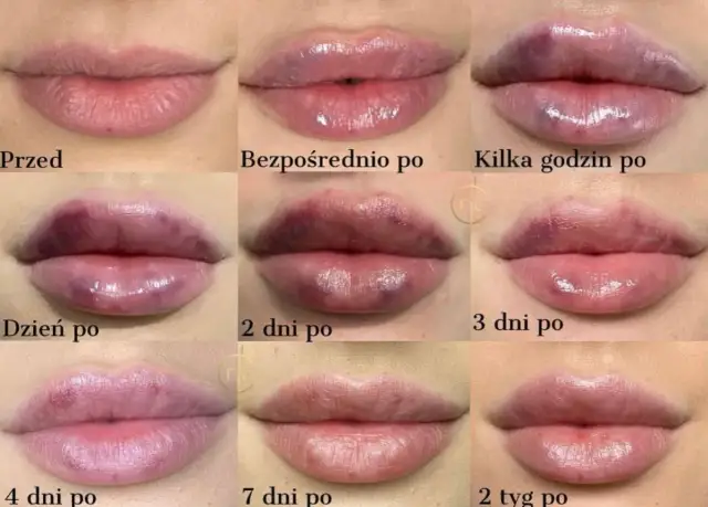 Jak bezpiecznie spać po powiększaniu ust? Porady eksperta