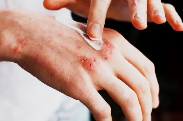 Alergia na sierść objawy skórne – jak rozpoznać i leczyć dolegliwości