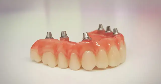 Proteza częściowa na NFZ z metalowymi elementami mocującymi, gotowa do implantacji.