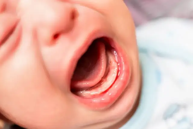 Usta niemowlaka z widocznym językiem i dziąsłami. Może to być związane z za krótkim wędzidełkiem u niemowlaka objawy.