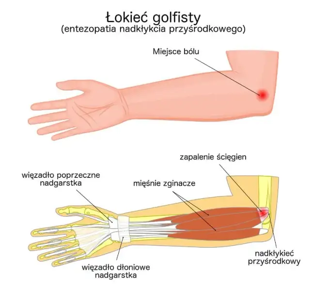 Łokieć golfisty: objawy, które musisz znać. Sprawdź, czy Cię dotyczą
