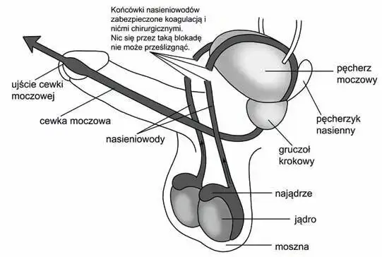Czy wazektomia to grzech? Moralne dylematy i nauka Kościoła