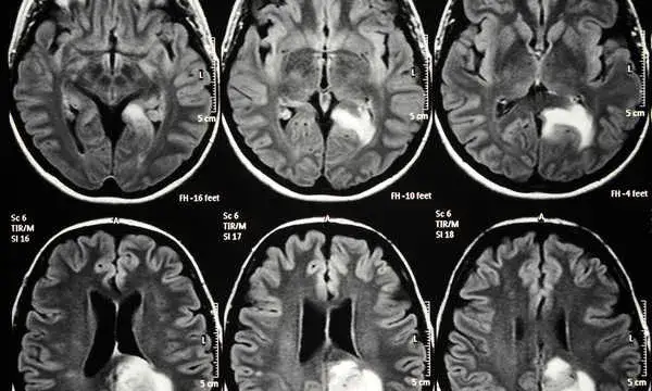 Czy rezonans magnetyczny wykryje chorobę psychiczną? Oto prawda