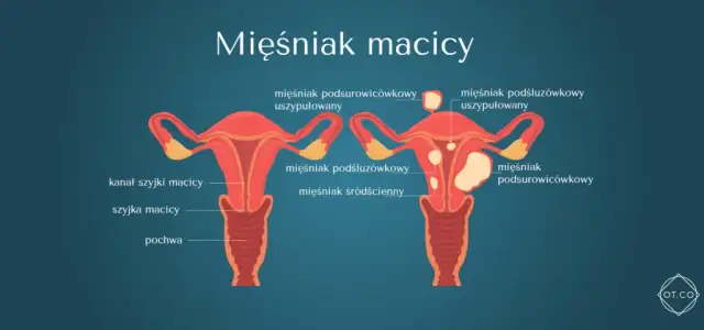 Rosnący mięśniak po menopauzie: Kiedy to sygnał alarmowy?