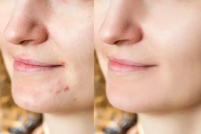 Pasta na pryszcze? Dermatolodzy ODRADZAJĄ! Poznaj fakty i alternatywy