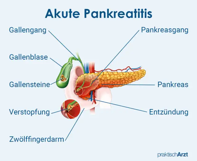Chronische Pankreatitis: Diagnose-Schritte & Symptome erklärt