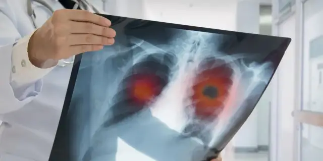 Die alarmierenden Symptome des Bronchialkarzinoms erkennen und verstehen