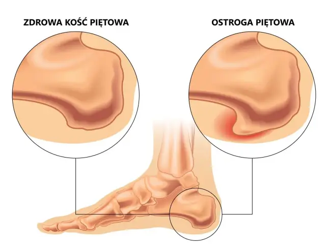 Ostroga piętowa: Jakie leki naprawdę pomogą? Kompleksowy poradnik.