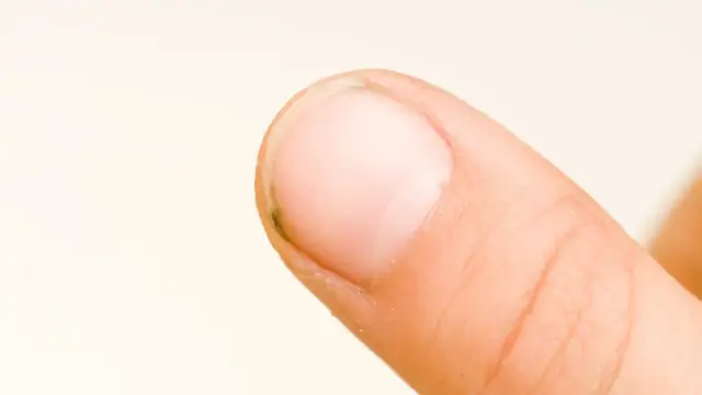 Zbliżenie na palec z widoczną macierzą paznokcia i niewielkim zabrudzeniem pod nim.