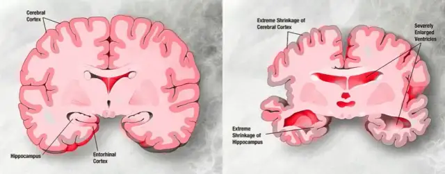 Jak zapobiec Alzheimerowi? Skuteczne sposoby na ochronę mózgu