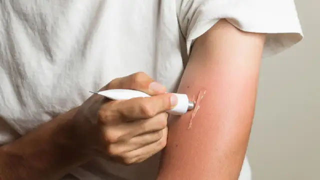 Nakładanie maści na oparzenia słoneczne na zaczerwienione ramię.