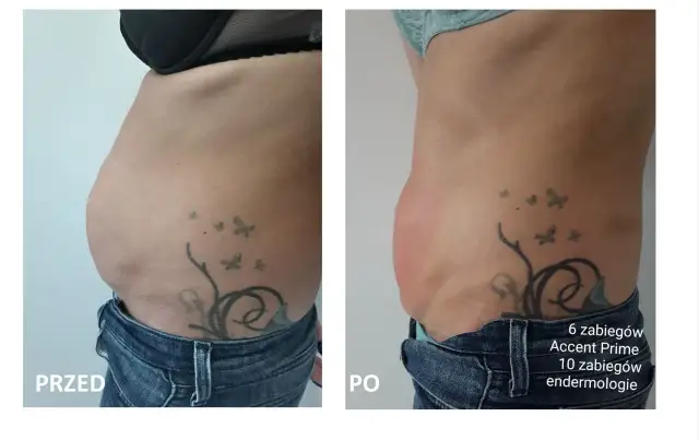 Przed i po zabiegu Accent Prime. Widoczna redukcja tkanki tłuszczowej brzucha, co pokazuje skuteczność liposukcji kawitacyjnej.