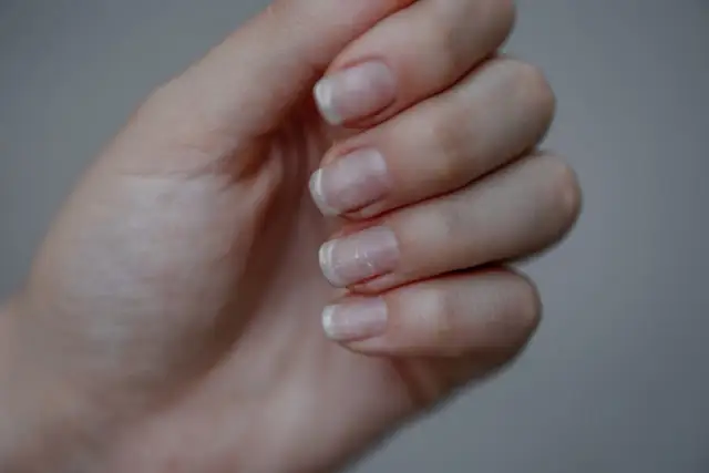 Dłoń z widocznymi białymi plamkami na paznokciach. Co jeść, by wzmocnić paznokcie?