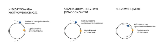 Schemat oka z ogniskowaniem światła przy krótkowzroczności i korekcji soczewkami.