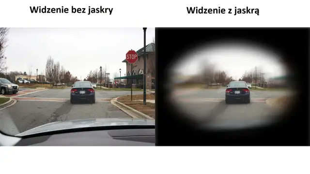 Porównanie widzenia: po lewej - normalne, po prawej - z jaskrą (widoczne ubytki w polu widzenia).
