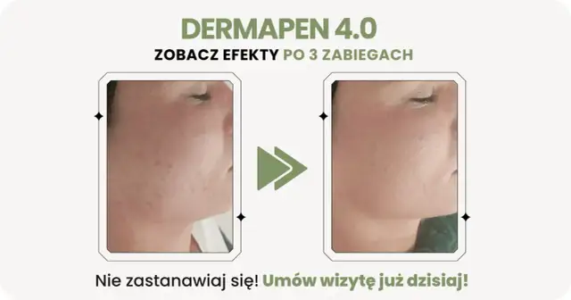 Przed i po zabiegu Dermapen 4.0: widoczne dermapen efekty po 3 zabiegach, skóra gładsza i bez niedoskonałości.