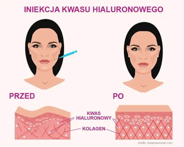 Doustny kwas hialuronowy: fakty o skórze i stawach. Czy działa?