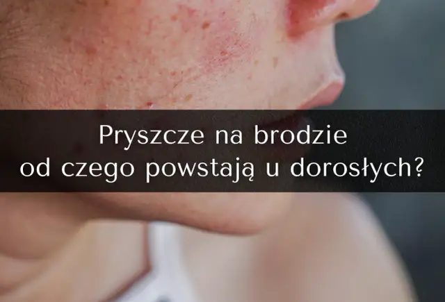 Pryszcze na brodzie: Jak się ich pozbyć? Kompletny poradnik ekspertki